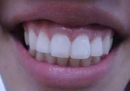 Snowhite Teeth Whitening- como aplicar - preço - pomada